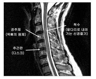 목디스크