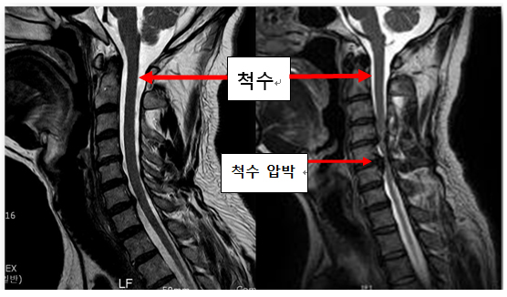 경추 시술