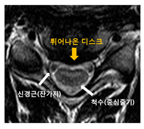 경추 시술