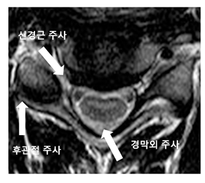 경추 시술