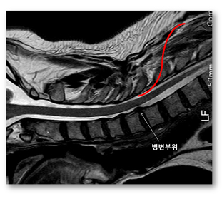 경추 시술