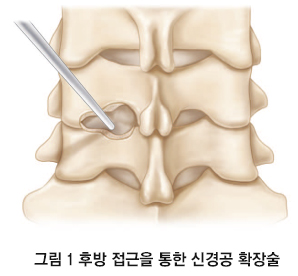 경추 수술