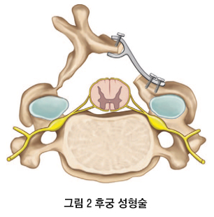 경추 수술