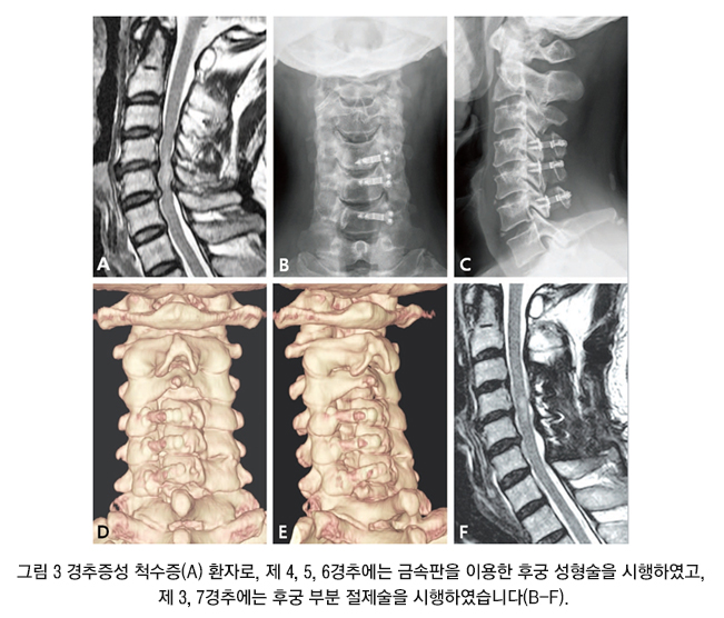 경추 수술
