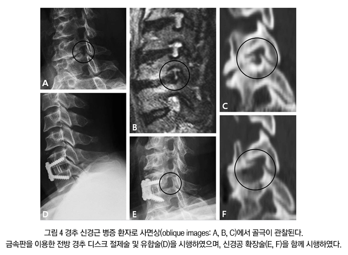 경추 수술