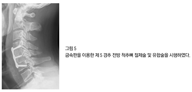 경추 수술