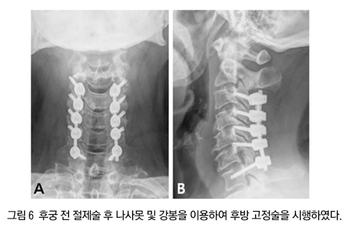 경추 수술