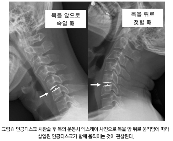 경추 수술