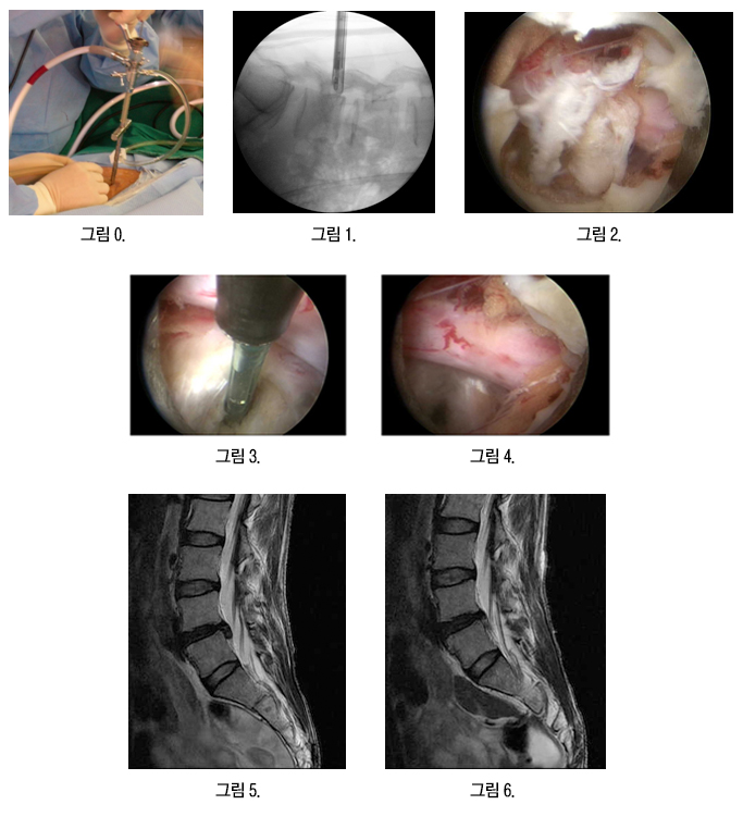 내시경 후방 접근법(Interlaminar approach) 수술 사진 7장 — 수술 장면, 투시 영상, 탈출된 디스크 노출, 제거 과정, 수술 전후 MRI