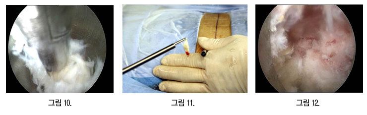 내시경으로 탈출된 디스크 수핵을 제거하는 과정(그림10·11)과 제거를 마친 뒤 내시경 시야(그림12)