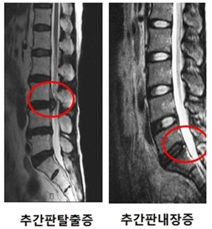 디스크내장증