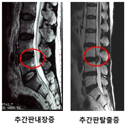 디스크내장증