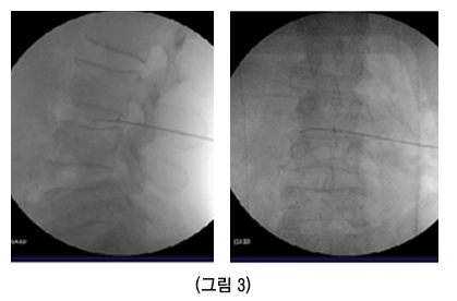 디스크내장증