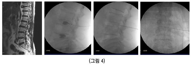 디스크내장증