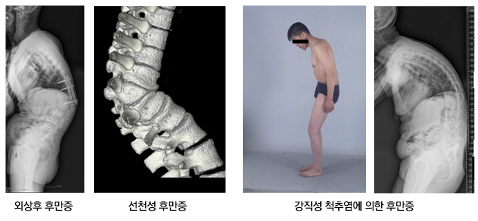 척추 후만증