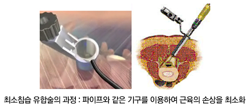 최소침습 요추유합술