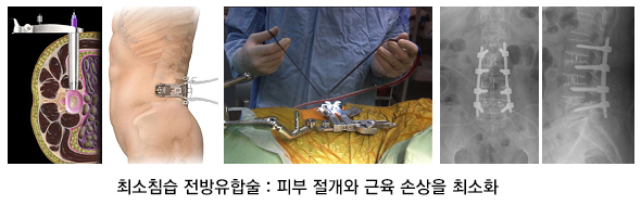 최소침습 요추유합술