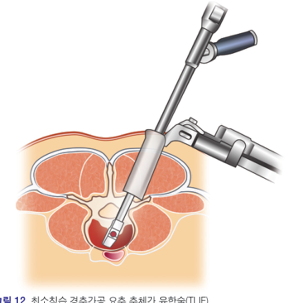 등 쪽에서 작은 통로를 내어 시행하는 최소침습 요추유합술(최소침습 TLIF) 모식도