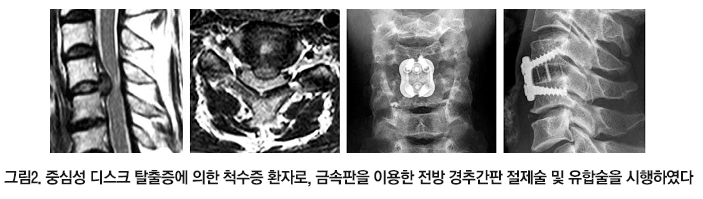 경추 척수증
