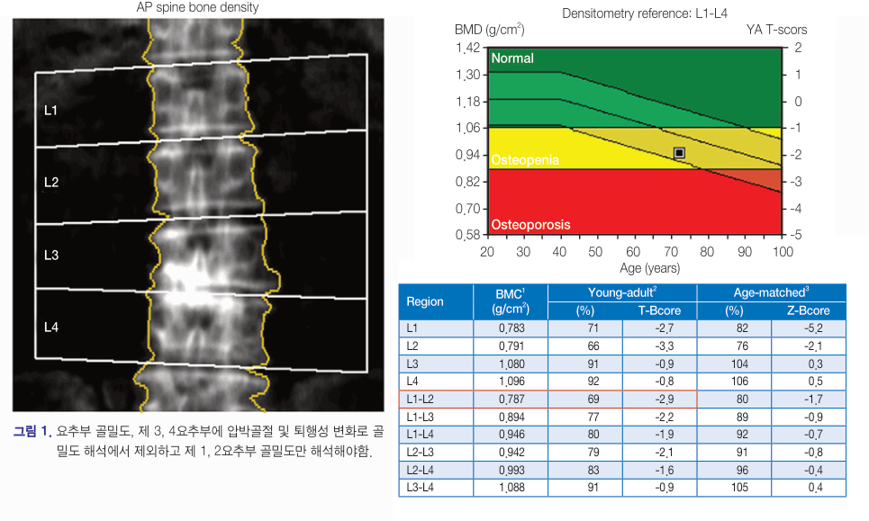 골밀도 검사 결과지의 예입니다. 허리뼈를 찍은 사진과 함께 T값이 표시되며, 초록색은 정상, 노란색은 골감소증, 빨간색은 골다공증 범위입니다.