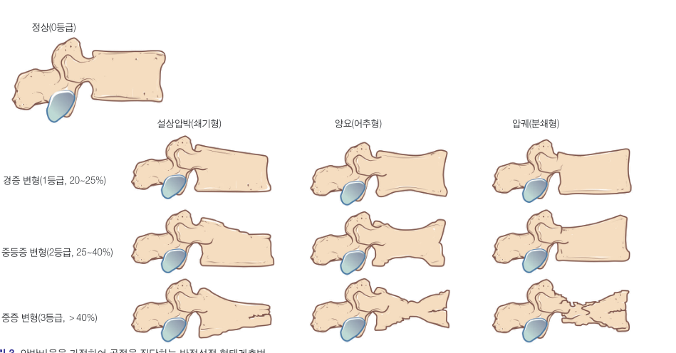 골다공증으로 척추뼈가 눌린 정도를 옆에서 본 그림입니다. 왼쪽 위가 정상이고, 아래로 내려갈수록 뼈가 더 많이 주저앉은 상태입니다.