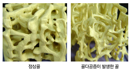 척추 골다공증