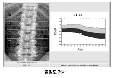 척추 골다공증