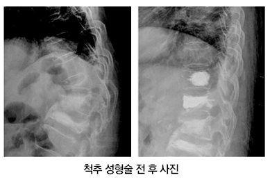 척추 골다공증