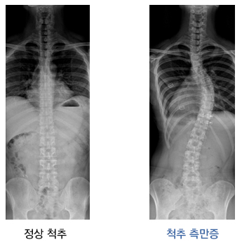 척추 측만증