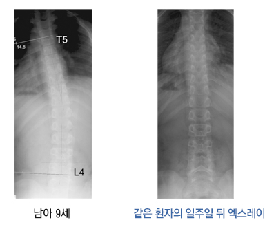 척추 측만증
