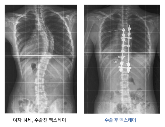 척추 측만증